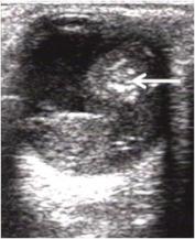 Figure 12: US of a 2 year old boy with leukocoria reveals an endophytically growing soft tissue mass in the posterior segment, with foci of calcification within (arrow) suggestive of
