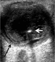 Figure 16: US reveals vitreous echoes and membranes with diffuse thickening of the chorioretinal layer (black arrow) suggestive of