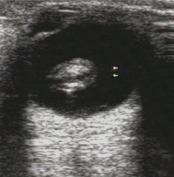 An echogenic foreign body (white arrow) with posterior acoustic shadowing is seen, which was the cause of endophthalmitis in this case.