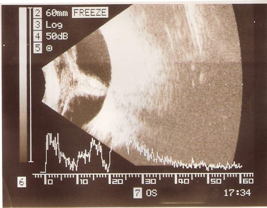 Fig. 1: Ultrasonography of the globe
