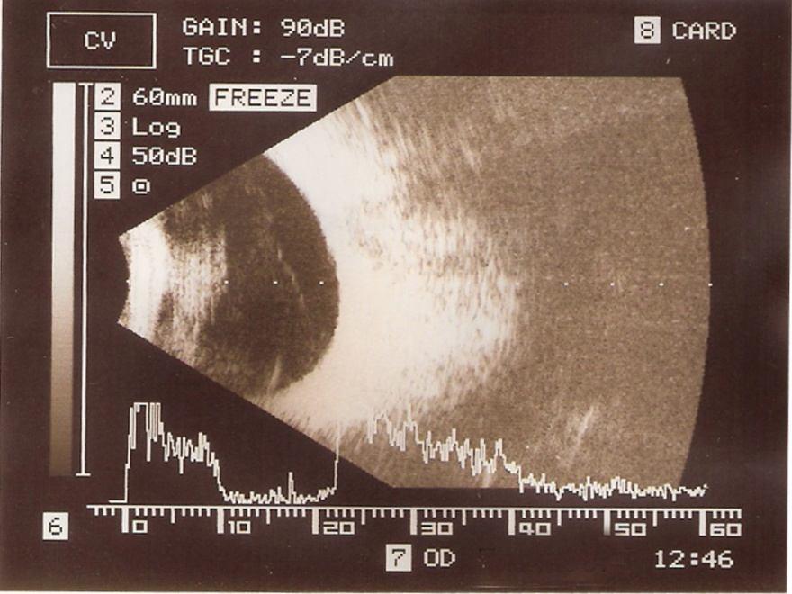 2: Ultrasonography of the globe shows