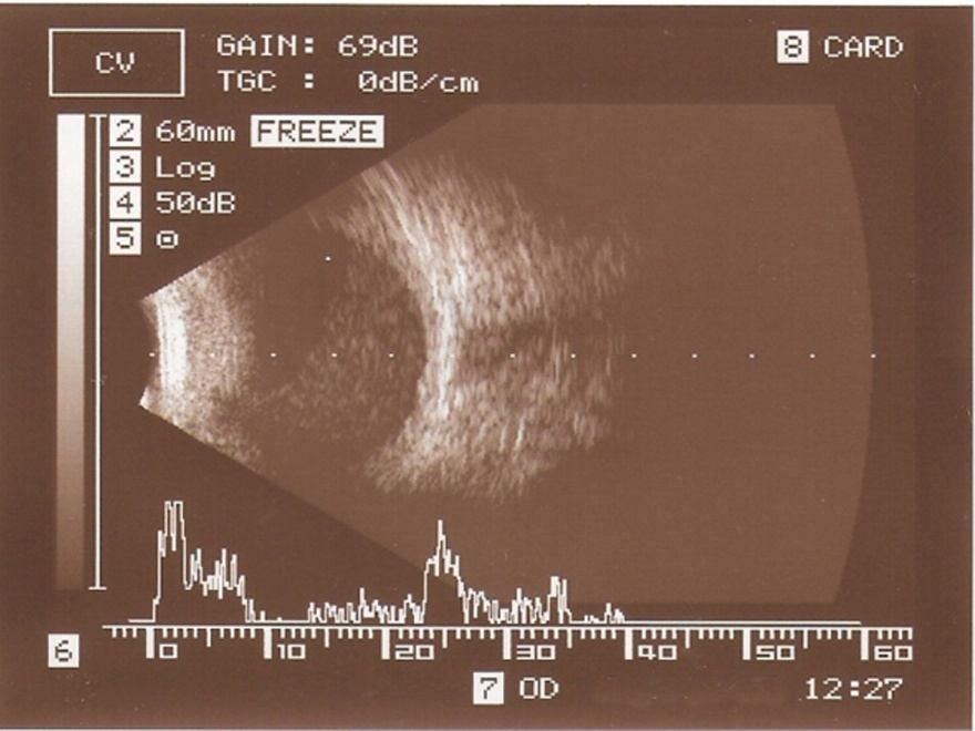 Fig. 3a: Ultrasonography of the globe shows