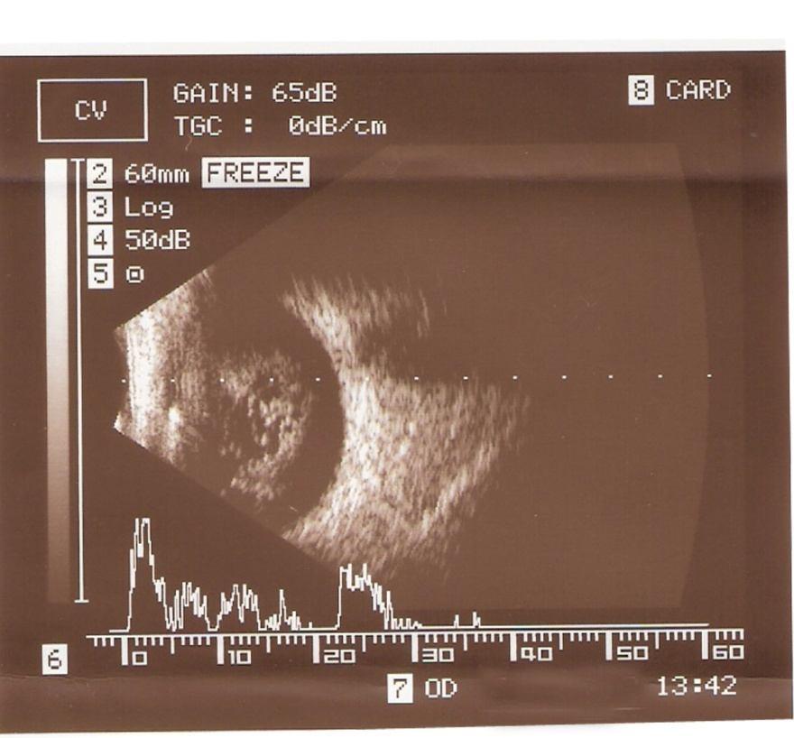 Fig. 4a: Ultrasonography of the globe shows