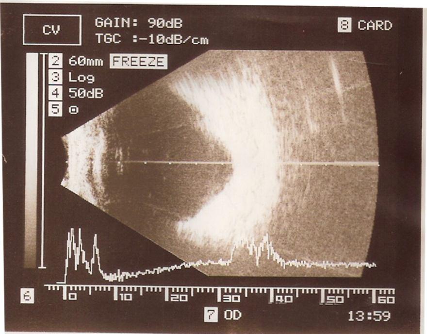 Fig. 5: Ultrasonography of the globe