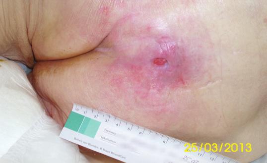 Treatment The wound was cleansed with a wound irrigation solution and gel (Prontosan, B Braun) prior to application of Askina DresSil to the sacral wound.