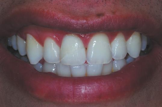 Clinical strategies for esthetic excellence in anterior tooth restorations: understanding color and composite resin selection and effective technique for color selection and reproduction of the