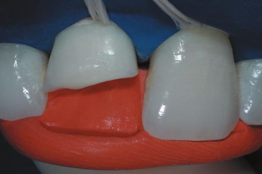 Clinical strategies for esthetic excellence in anterior tooth restorations: understanding color and composite resin selection Figure 3- Shade selection performed on a clean tooth under
