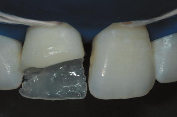 Note the translucency achieved by Amaris TL, ideal to reproduce the enamel that was lost Internal artificial dentin In natural teeth, there is a progressive decrease in chrome from the