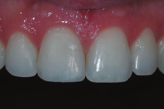 enamel. Also, a resin with opaque and translucent characteristics should be used to mimic the effect of opalescent halo and reproduce the incisal translucency, respectively 2 (Figure 8).