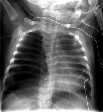 PPB Mimicking Congenital Pulmonary Airway Malformation Haider et al. e11 Fig. 1 AP chest radiograph. due to the new classification system established by Stocker et al.