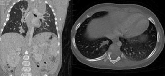 PPB Mimicking Congenital Pulmonary Airway Malformation Haider et al. e13 Fig. 7 Six-month follow-up CT. Fig. 8 Two-year follow-up. affected parent was the father.