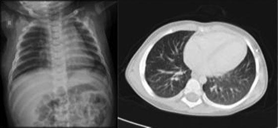 9 In the case reported, pneumothorax was highly suspected, but it was unilateral with involvement of a single segment with a definite complex cyst, so he had two out of four of the symptoms, as