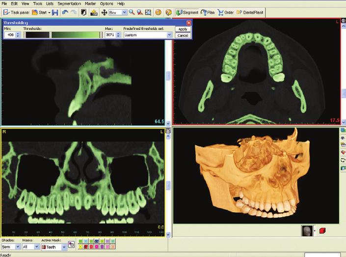 Clinical A B C Figure 4a c. A) SimPlant automatically generates panoramic, cross-sectional, and volume-rendered 3D views from axial slices.