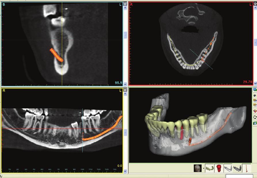 A B Figure 6a b. A) CBCT images of a mandible (taken on an i-cat). The inferior alveolar nerve can be clearly seen on the patient s right in the panoramic view.