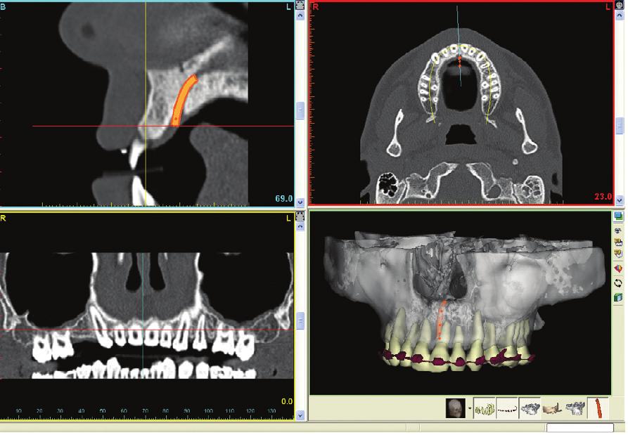 The incisive foramen has been drawn in orange. The maroon object in the 3D image shows the patient is wearing orthodontic braces.