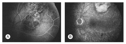 Fluorescein angiography Early hypofluorescence with late hyperfluorescence Rarely useful to differentiate from other lesions Prognosis & Treatment Prognosis Mean life expectancy 9 10 months Treatment