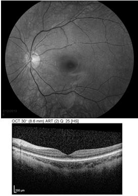 Ophthalmol 1869;15:1, Confinia Neurol 1954;14:184, Ophthalmologica 1947;114:332) Clinical features Normal fundus appearance RPE granularity Vessel attenuation Macular coloboma