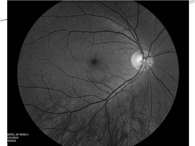 Not uncommonly, triamcinolone stained residual layer of vitreous over the posterior and peripheral retina in many eyes with retinal detachment (including some with a preexisting Weiss ring)