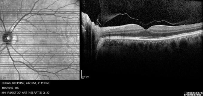 detachments Lincoff Rules (Lincoff H, Gieser R. Finding the Retinal Hole. Arch Ophthalmol. 1971;85(5):565) RD, but no break found?