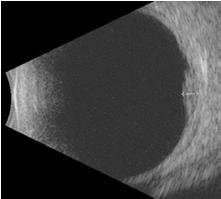 leopard spotting in breast ca) Exudative RD Ultrasonography A scan: Moderate high