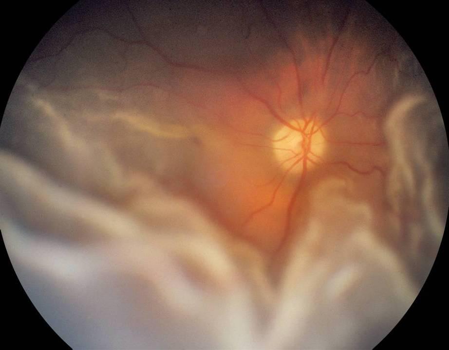 Pseudophakic RD with multiple, small breaks If you perform vitrectomy only, do you