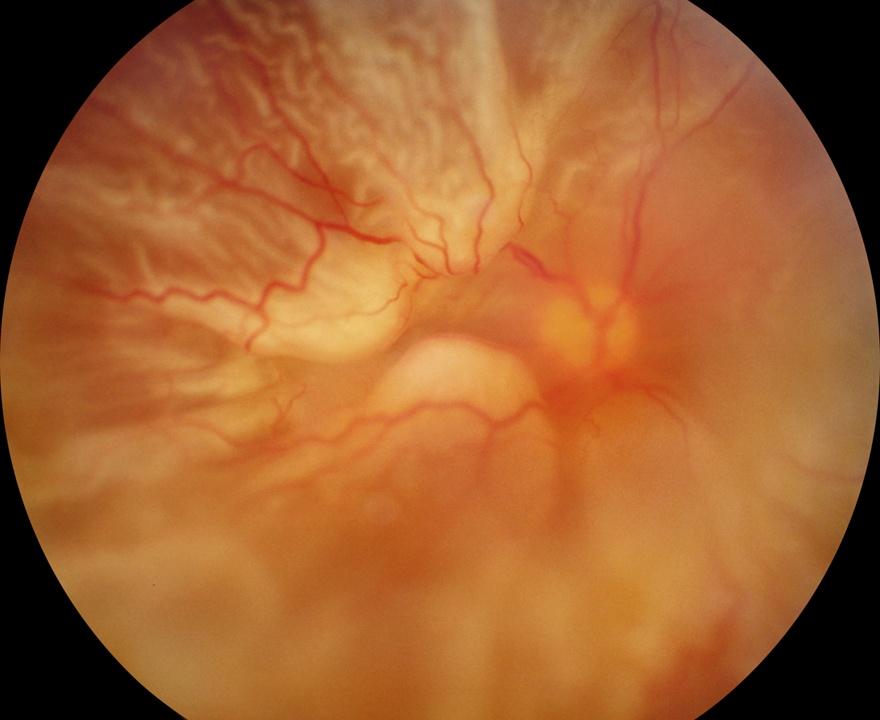 Recurrent pseudophakic retinal detachment with early PVR, four weeks after surgery Do you