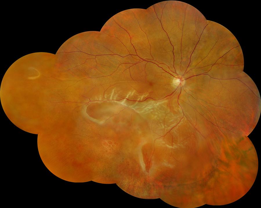 Retinoschisis and retinal detachment Full thickness