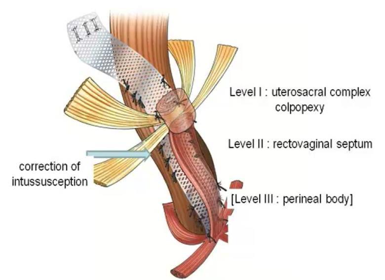 Perineal levatorplasty and Laparoscopic