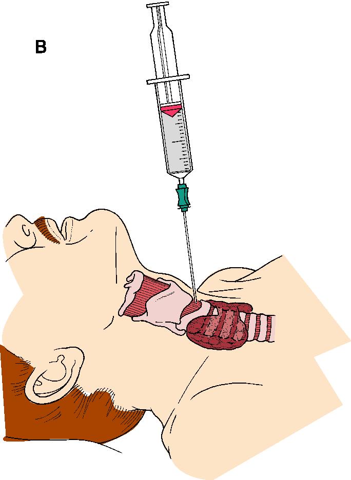 Needle Cricothyroidotomy D29 Indication Failure to provide an airway by any other means