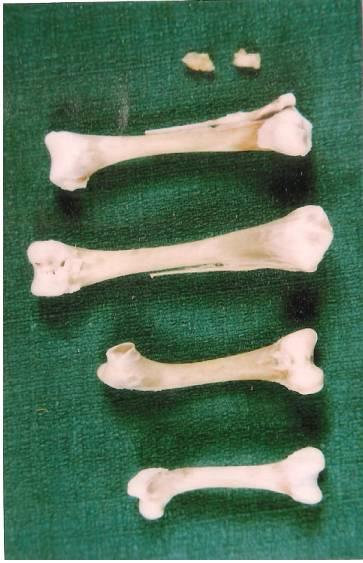 Bradley O C stated that the distal end of femur possesses a deep, pulley shaped surface for the patella and two convex condyles for articulation with the tibia and fibula of the leg.