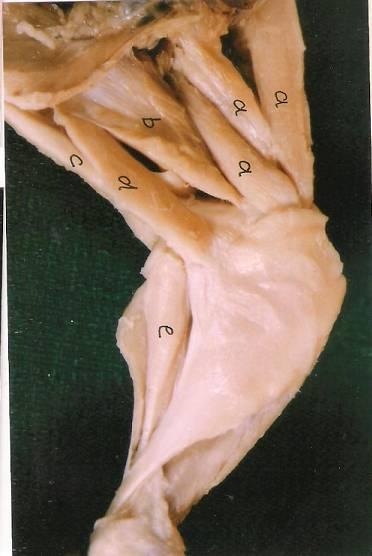 The lateral condyle is broader than the medial condyle.