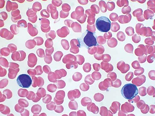 Yoshioka Y, et al. Table 1. Laboratory data of this case Hematology Chemistry Serology White blood cell 17.9 10 9 /L Total protein 7.1 g/dl HTLV-1 (-) Neutrophil 14.0% Albumin 4.