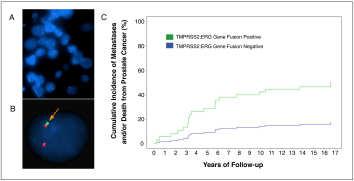 Surveillance: erg Fusion Effect on Prostate Cancer Mortality Urinary Test