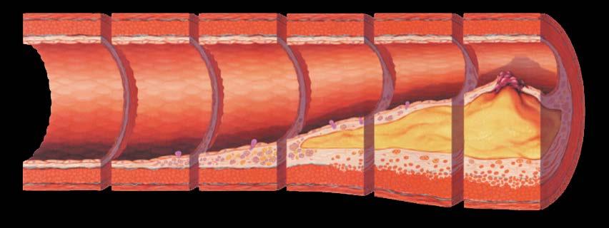 Atherosclerosis: Roles of Inflammation and Endothelial Dysfunction Foam cells Fatty streak Intermediate lesion Atheroma Fibrous plaque Complicated lesion/rupture Endothelial dysfunction From first
