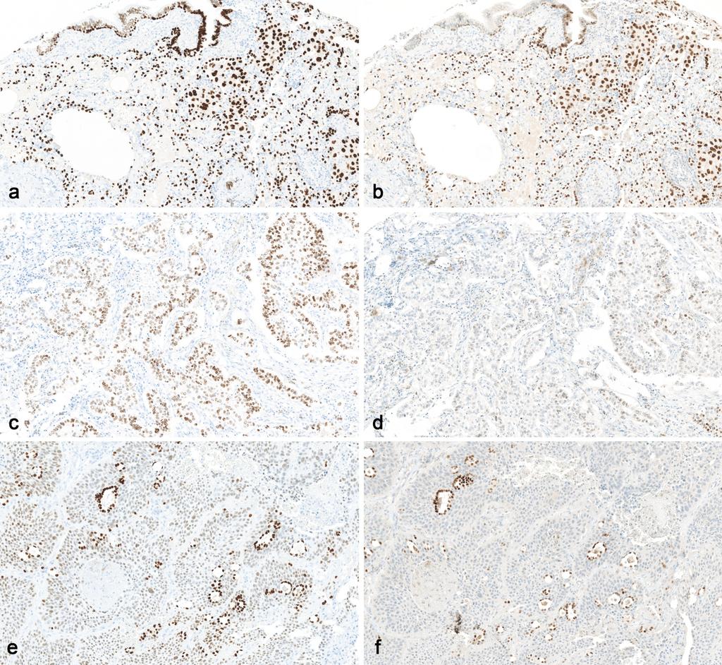 Lung adenocarcinomas Lung squamous cell carcinoma 8G7G3/1,