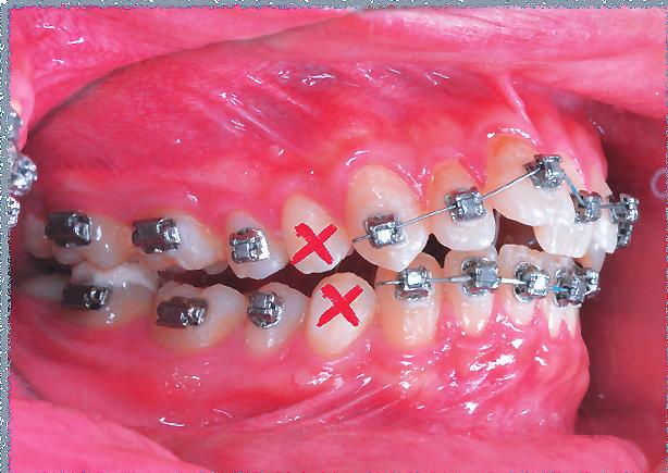 Bonding Procedures for Insignia JDO 49 Fig. 6: For the premolar extraction case shown, teeth with red Xs will be extracted.