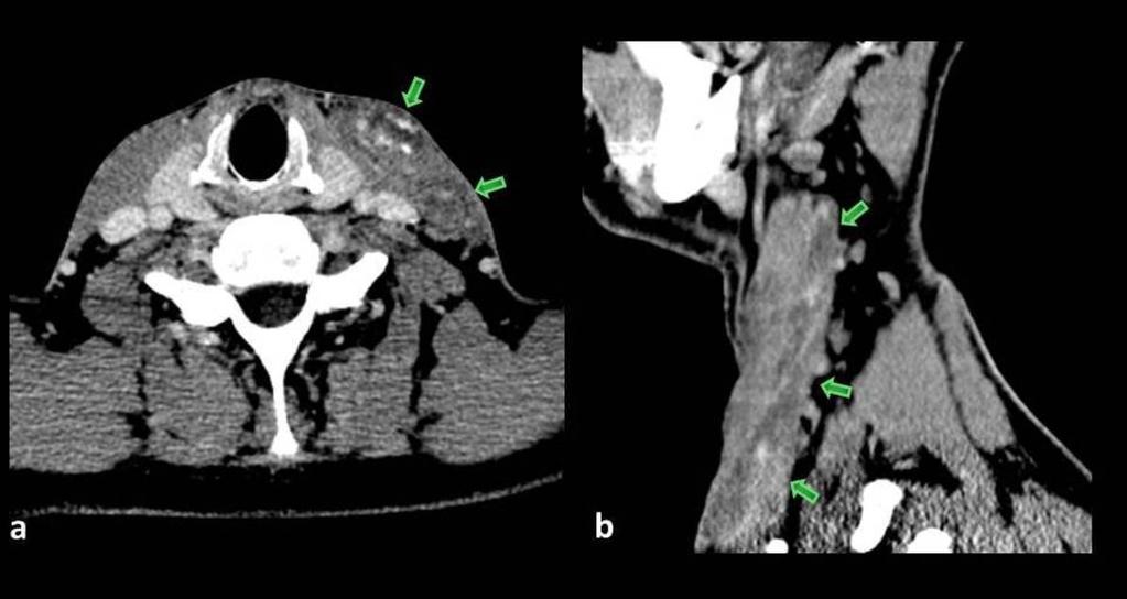 Fig. 8: 11-month old infant: Axial non-enhanced CT scan (a) and coronal contrastenhanced reformat (b) show a macrocystic lymphatic malformation (arrows) in the right cervical region,