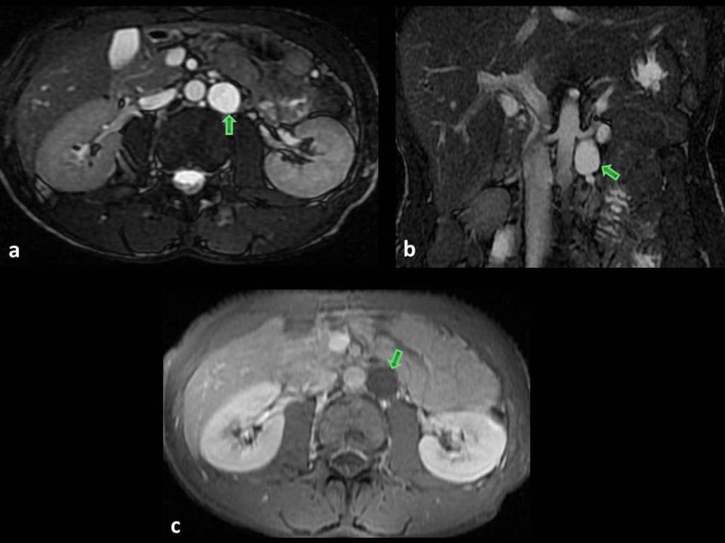 Fig. 10: A case of retroperitoneal lymphatic aneurysmal dilatation: Axial contrastenhanced CT scan (a) and coronal reformat (b) show a homogeneous, fluid-attenuating, well-demarcated cystic lesion
