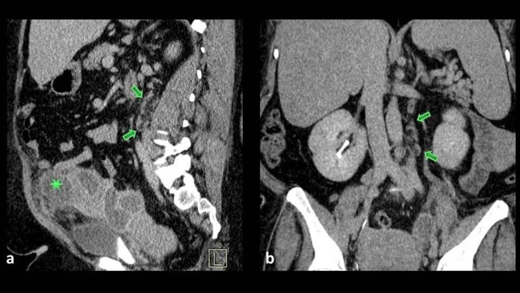 Fig. 12: Sagittal (a) and coronal (b) contrast-enhanced CT reconstructions of a patient with a left ovarian cystic tumor (asterisk), incidentally shows a left para-aortic