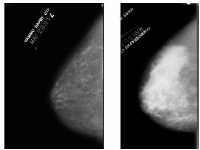 Mammogram consists of images of fat, glandular, blood vessels, fibrous tissues and/or any abnormalities.