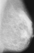 Normal Case Classification Normal mammogram features has a high variance (from various