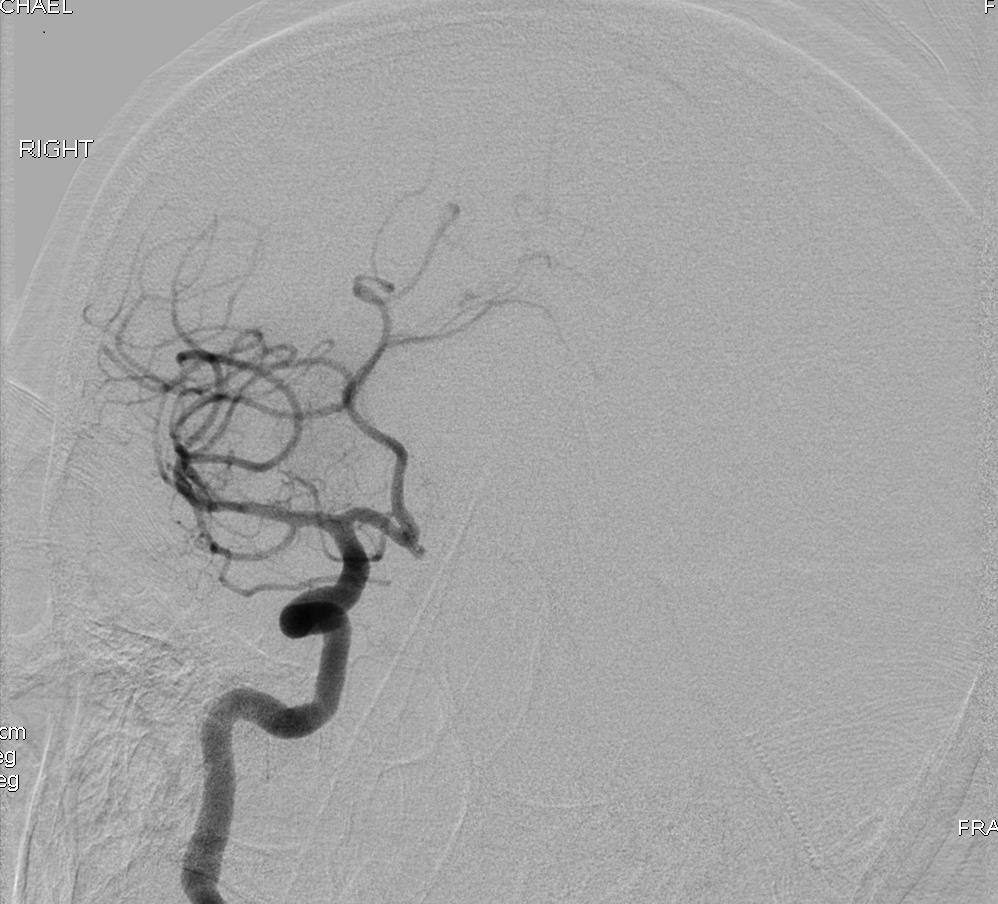 Case # 3 LSW to revascularization (2 hours and 26
