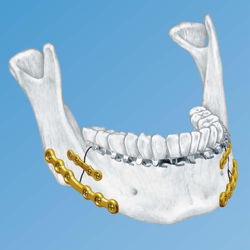 2.0 MM MANDIBLE LOCKING PLATE SYSTEM Advanced plating system for trauma, microvascular reconstruction, and orthognathic surgery: Provides locked or nonlocked,