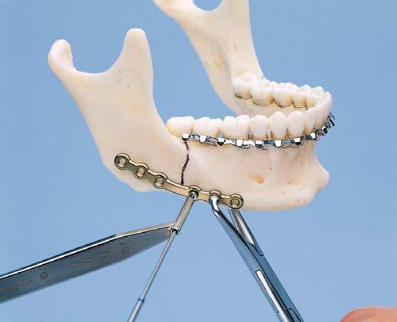 If plate requires placement over nerve or tooth root, drill monocortically using the appropriate drill bit with stop.