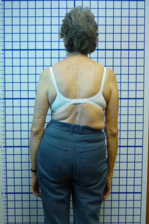Case 6 Results: Immediate improved torso