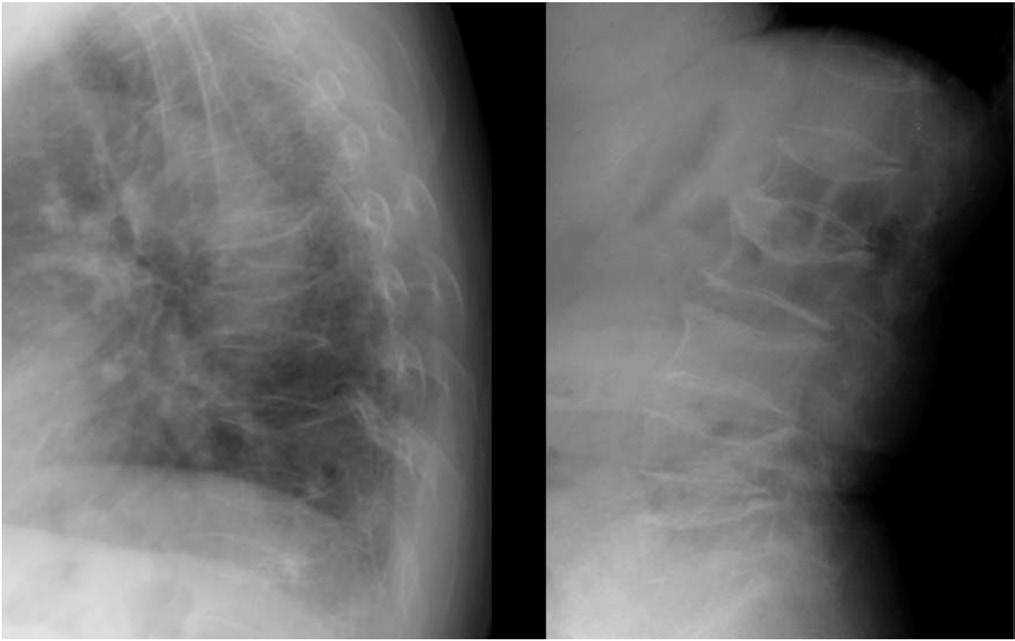 shin dy, et al. Fracture during bisphosphonate therapy 99 CASE REPORT A 63-year-old woman was admitted to hospital because of severe pain in both anterior thighs for 5 months.