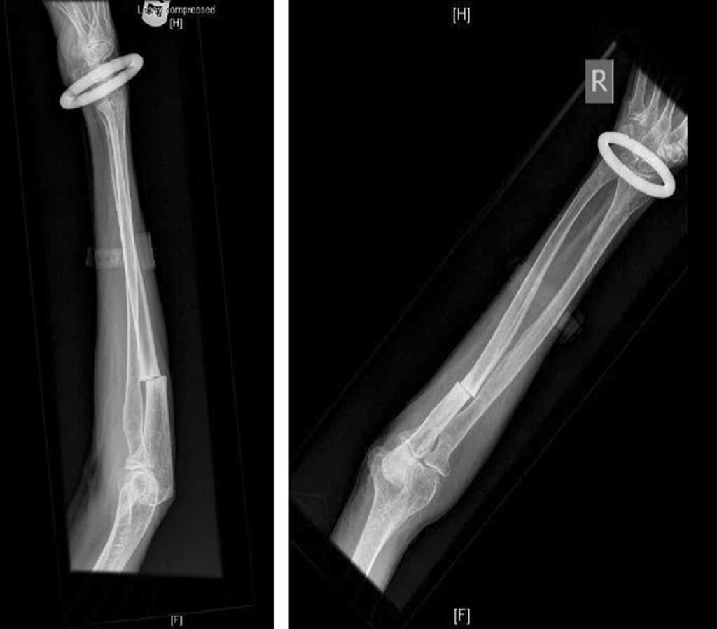 she suffered an atraumatic fracture of the right ulna requiring surgical fixation.