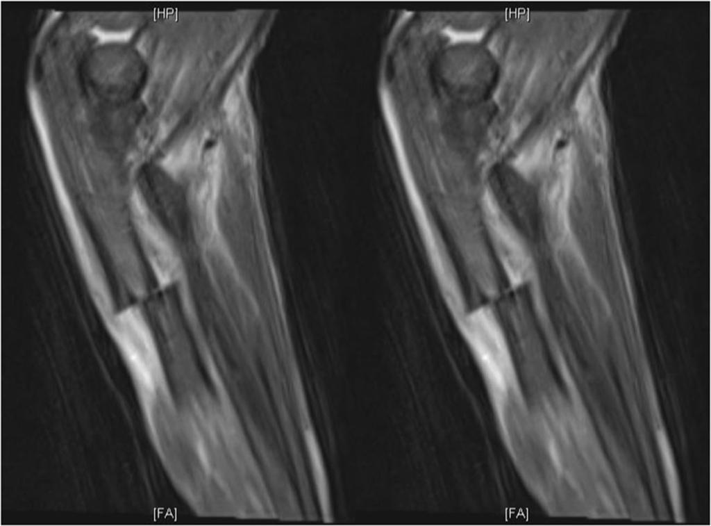 Fig. 2 Magnetic resonance imaging of the right elbow shows a stress fracture of the midshaft of the ulna fracture as a linear area of low signal intensity.