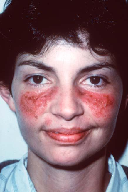 When You Should Suspect SLE Seborrheic dermatitis Lupus Acne rosacea Red cheeks