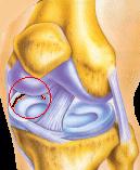 Meniscus Cruciate Ligaments Anterior Cruciate Ligament: comprises three twisted bands: the anteromedial, intermediate, and posterolateral bands.
